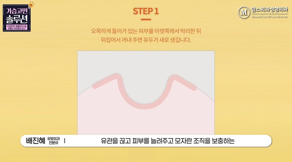 함몰유두수술의 성공을 위한 포인트는? 관련 이미지 12