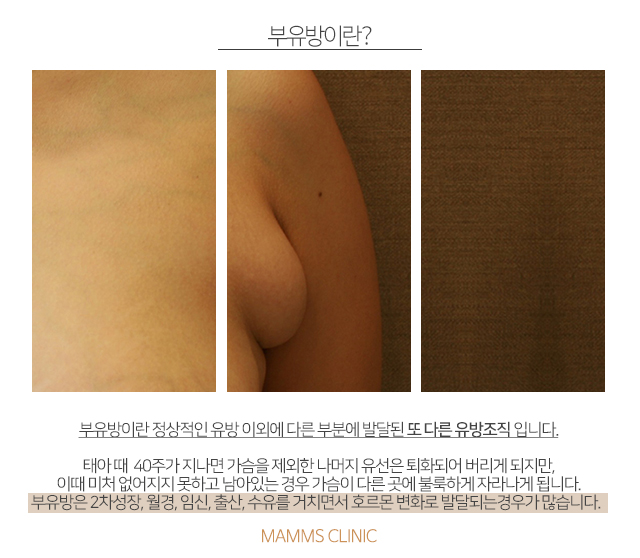 암산부부유방 늦기전에 관련 이미지 2
