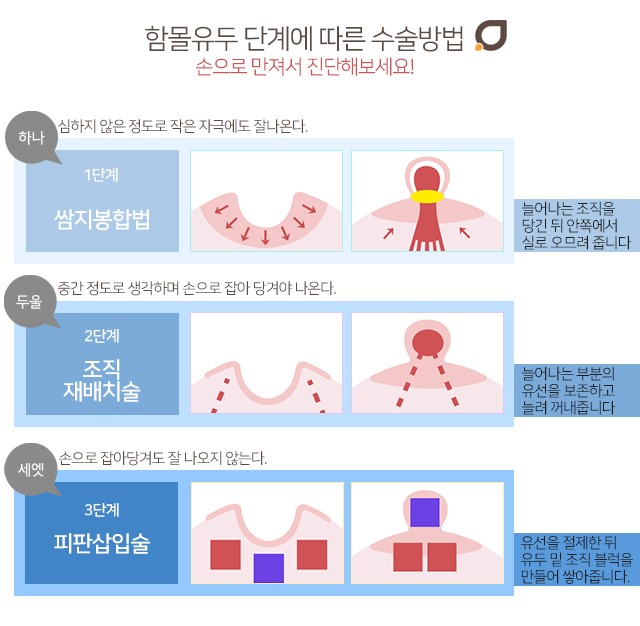 함몰유두수술후기 하나하나따져봐야죠 관련 이미지 3