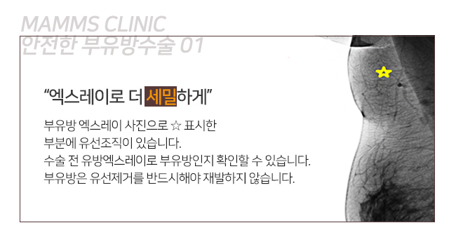 부유방주사 보다근본적으로 관련 이미지 4