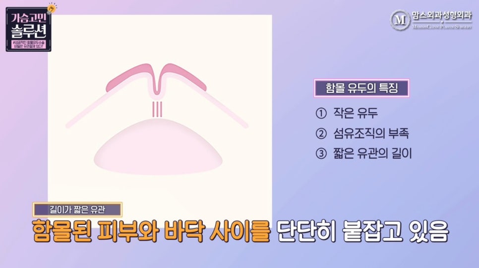 함몰유두수술의 성공을 위한 포인트는? 관련 이미지 5