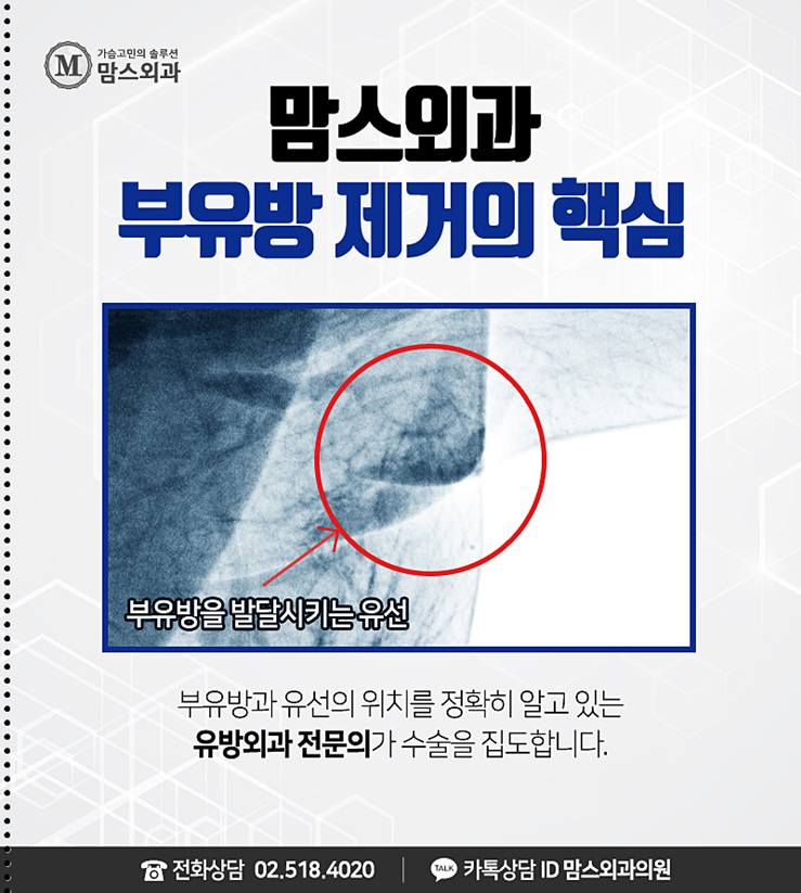 겨드랑이부유방수술 이제는 매끈하자! 관련 이미지 5