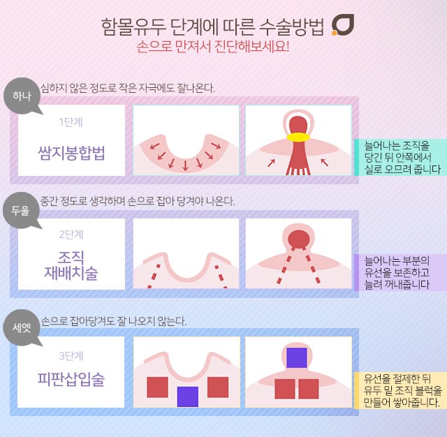 함몰유두교정기 한계가느껴진다면 관련 이미지 3