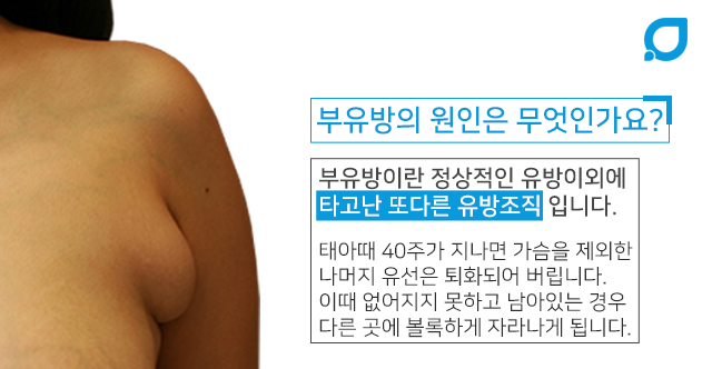 부유방원인 근본적인해결 관련 이미지 2