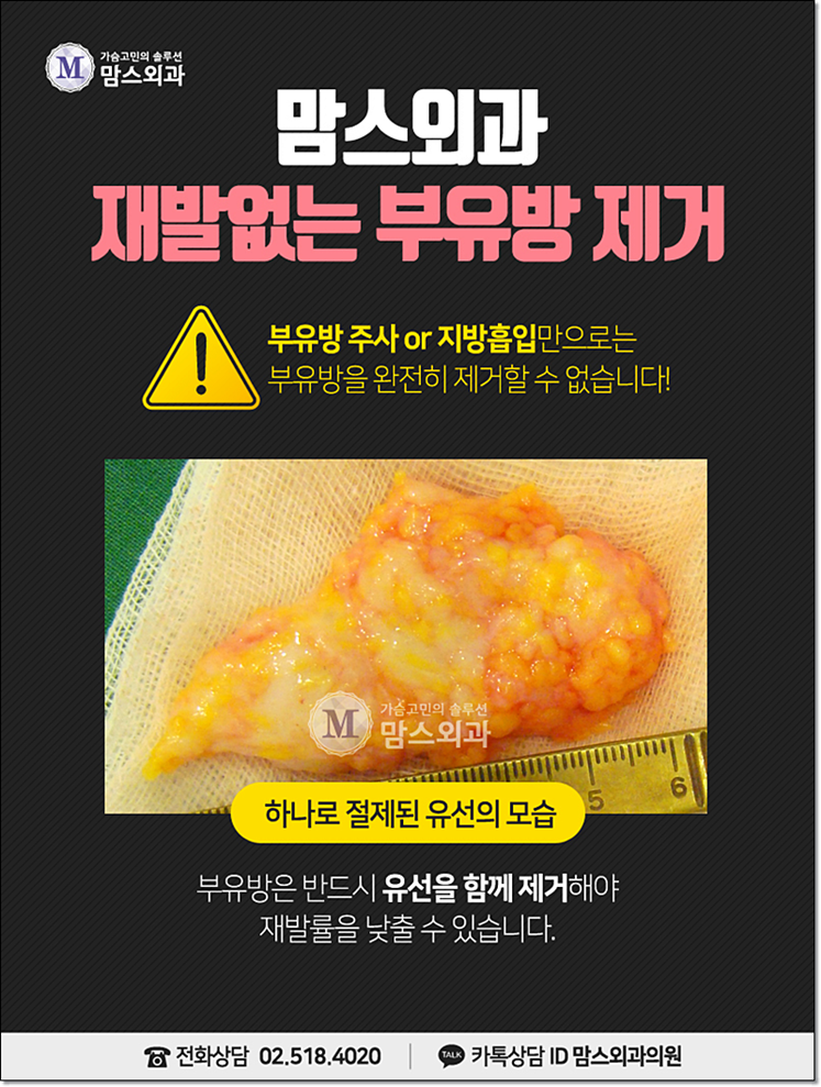 부유방제거비용 부담을 줄일 수 있나요? 관련 이미지 6