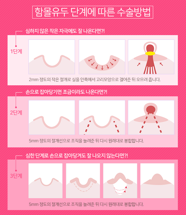 임산부함몰유두 늦기전에 관련 이미지 3