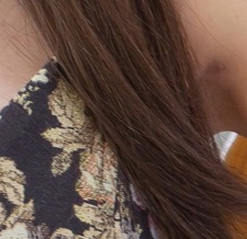 부유방제거수술 생각을 다지고 관련 이미지 25