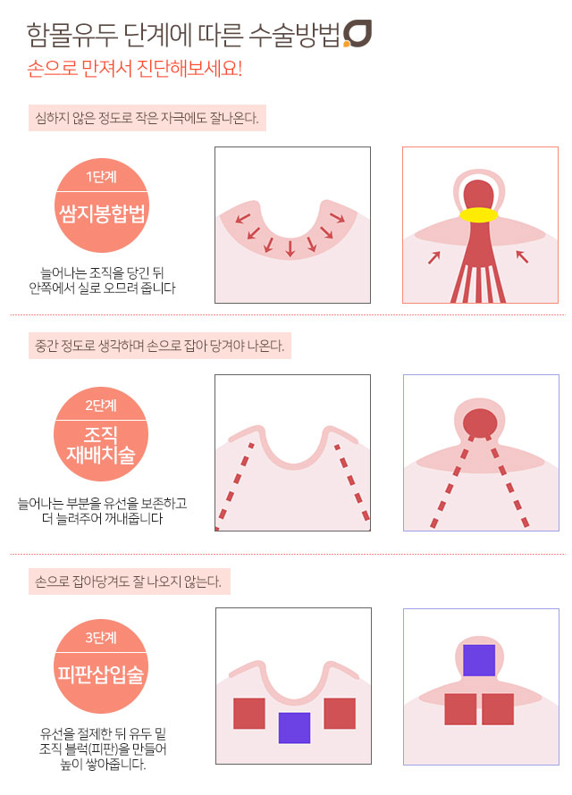 함몰유두증상 수유까지 고려해야죠 관련 이미지 2