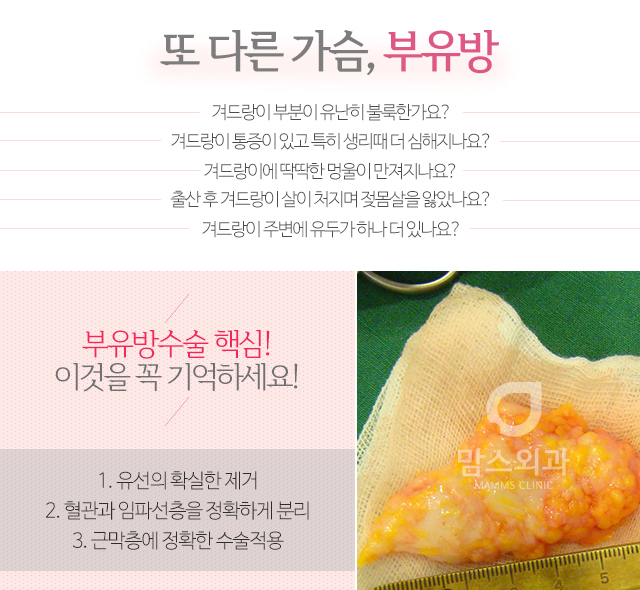 겨드랑이멍울 혹시나도부유방? 관련 이미지 2