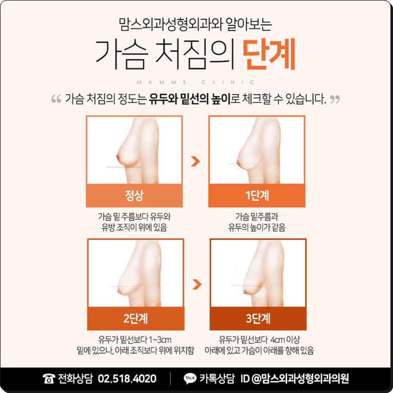 수유후처진가슴 콤플렉스엔 관련 이미지 6