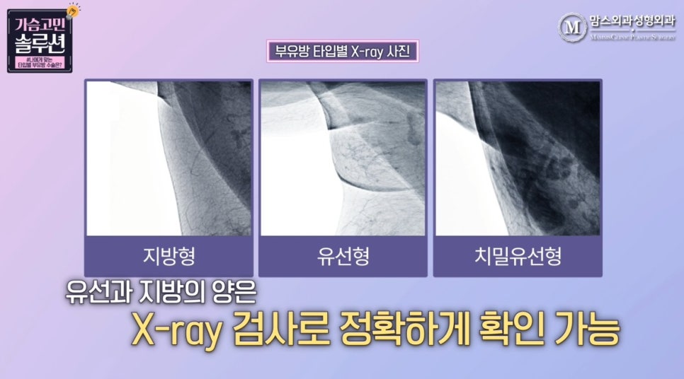 부유방제거수술 유형별 수술 방법은? 관련 이미지 4