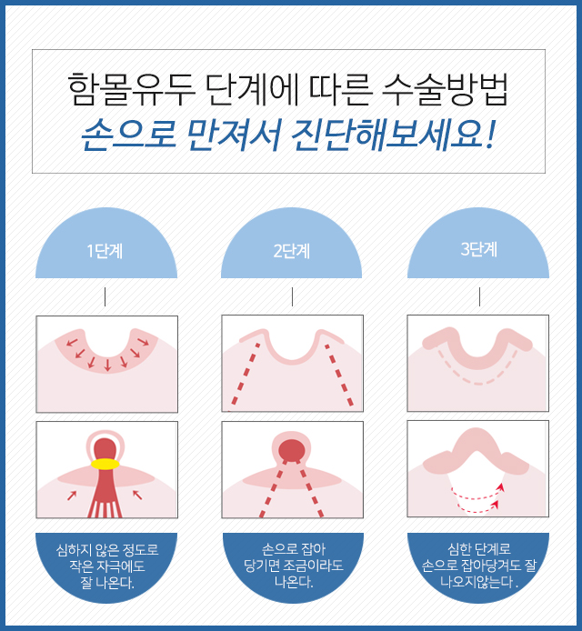 유두함몰 맘스에서 해결 관련 이미지 3