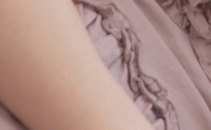 Why Should You Choose Accessory Breast Surgery Instead of Accessory Breast Injections? image 22