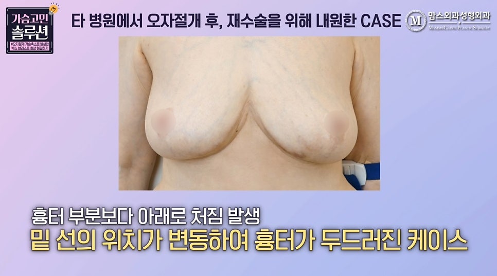 Can breast reduction revision surgery be done with a vertical incision after an inverted-T incision? image 4