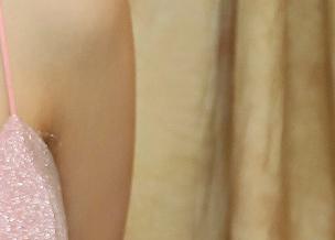 겨드랑이부유방제거 원인에 따라 수술 방법도 다르게 해야 하는 이유! 관련 이미지 19