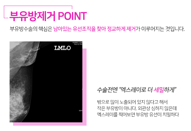 부유방제거수술 한번에해결 관련 이미지 4