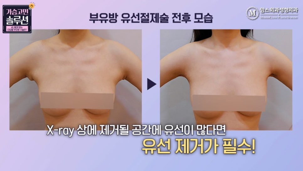 부유방제거수술 유형별 수술 방법은? 관련 이미지 9