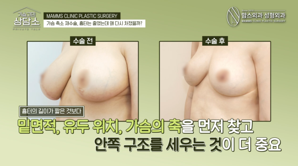 가슴축소재수술, 수직절개 후 다시 처진다면? 관련 이미지 7