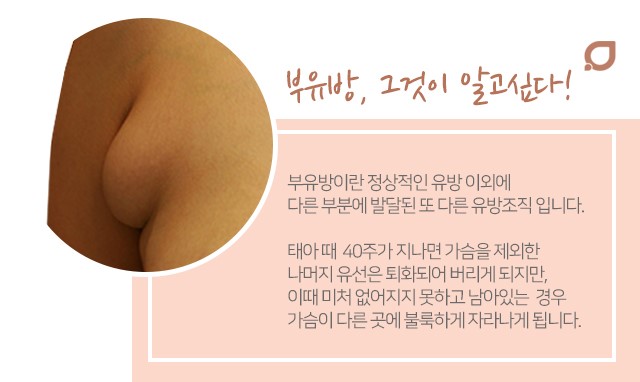 겨드랑이통증 방치마세요 관련 이미지 2