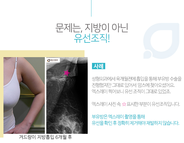 부유방주사 효과가없다면 관련 이미지 4