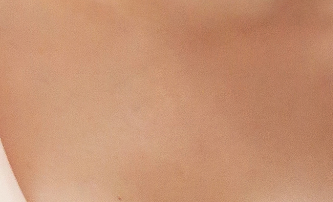 Personalized Accessory Breast Surgery Tailored to Your Axillary Skin Condition! image 17