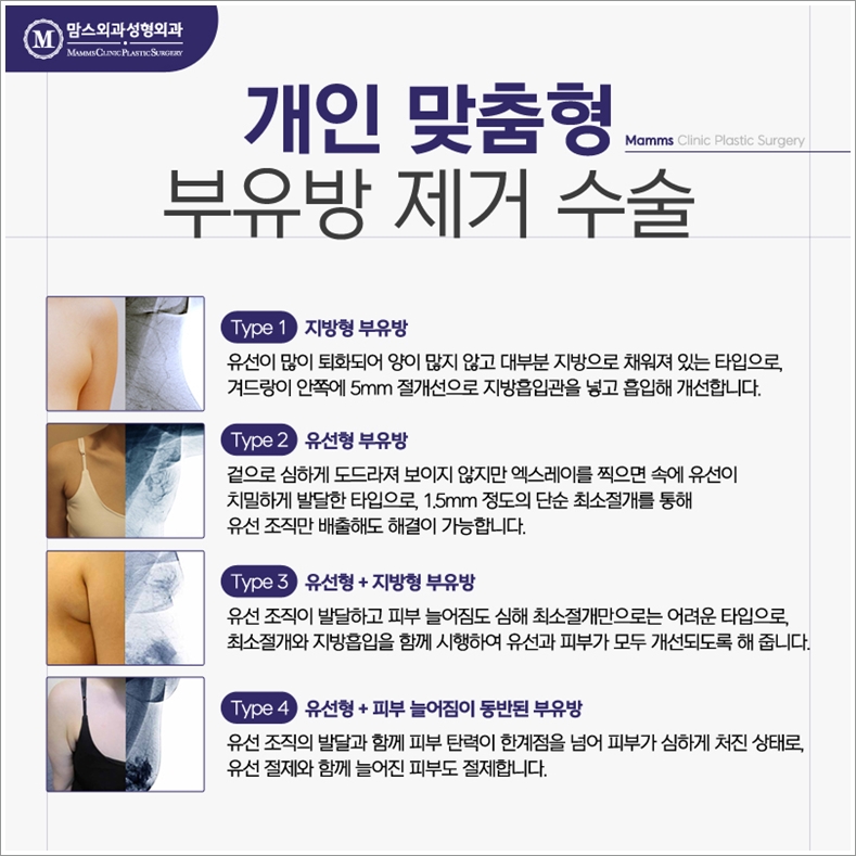 겨드랑이지방흡입 자꾸만 생각이 난다면? 관련 이미지 8
