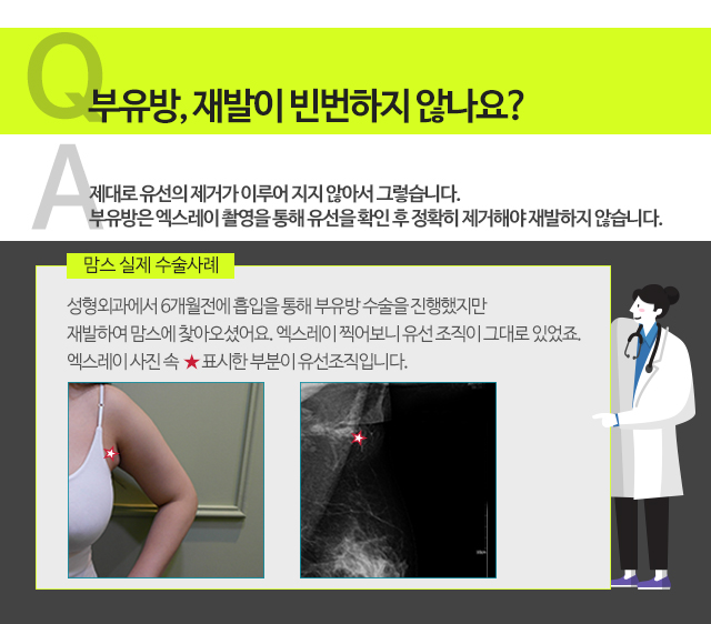 부유방제거수술비용 만큼중요한것 관련 이미지 2