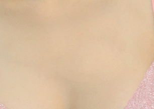 겨드랑이부유방제거 원인에 따라 수술 방법도 다르게 해야 하는 이유! 관련 이미지 18