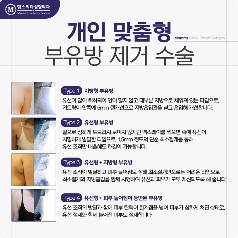 부유방지방흡입 무엇을 기준으로? 관련 이미지 7