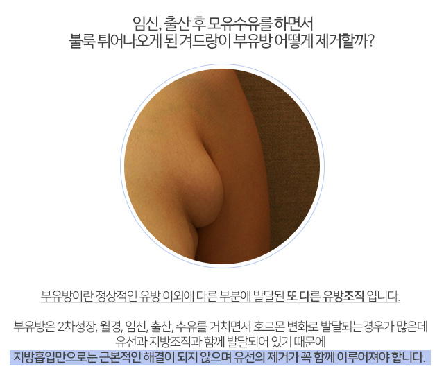 부유방지방흡입 근본적원인체크 관련 이미지 2