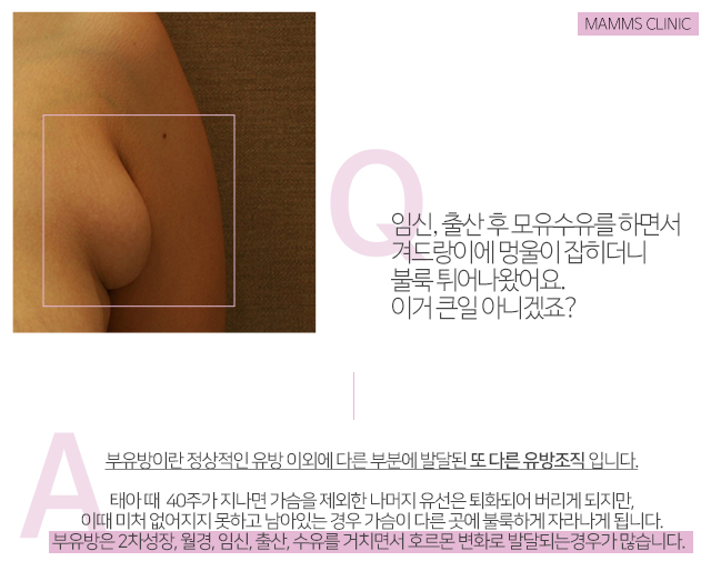 모유수유겨드랑이멍울 갑자기생겼다 관련 이미지 2