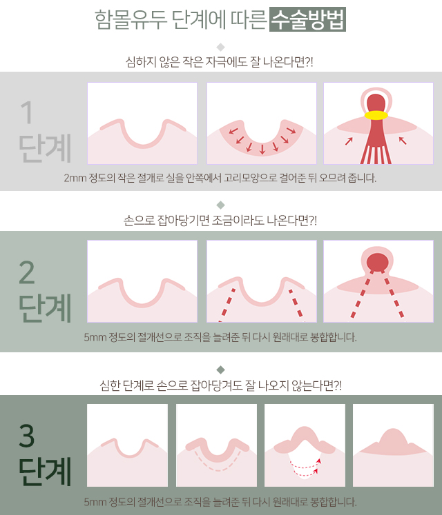 함몰유두치료 당당함을위해 관련 이미지 4