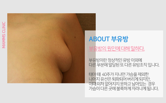 부유방수술후기 근본을찾아서 관련 이미지 2