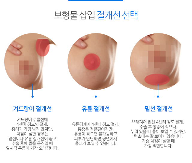 가슴확대수술전후 안전하고 아름답게 관련 이미지 3