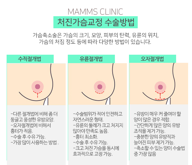 가슴처짐교정 모양과촉감까지 관련 이미지 3