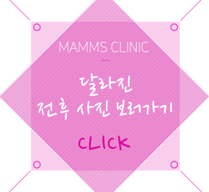 가슴처짐증 말못할고민 관련 이미지 6