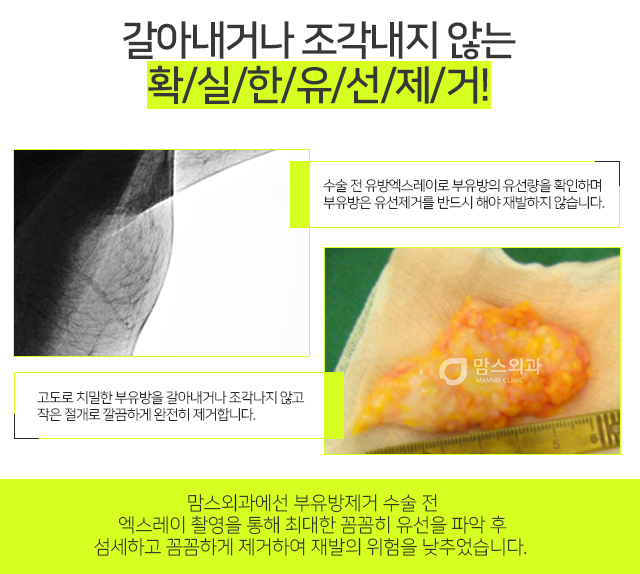 부유방제거수술비용 만큼중요한것 관련 이미지 3