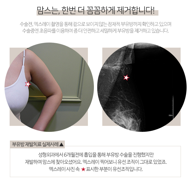부유방제거수술 한번에깔끔하게 관련 이미지 3