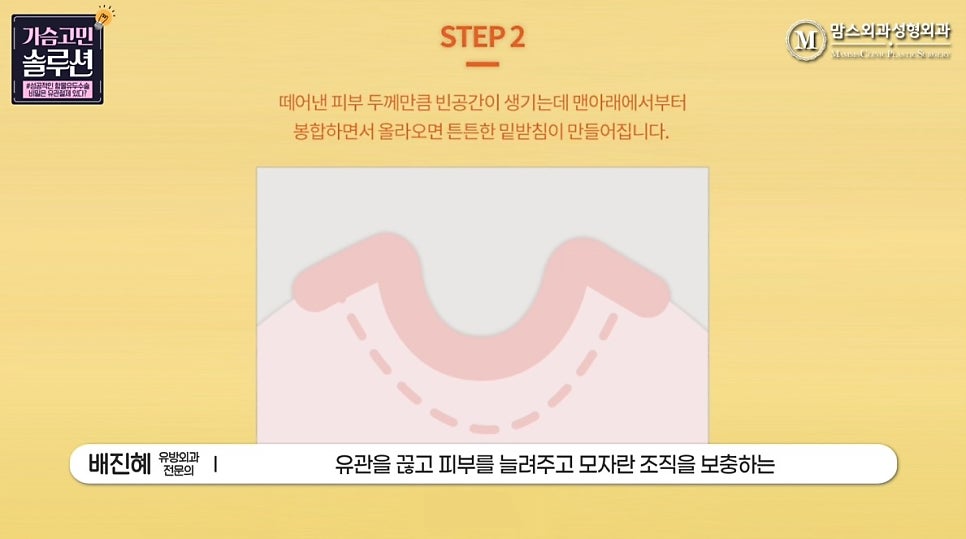함몰유두수술의 성공을 위한 포인트는? 관련 이미지 13