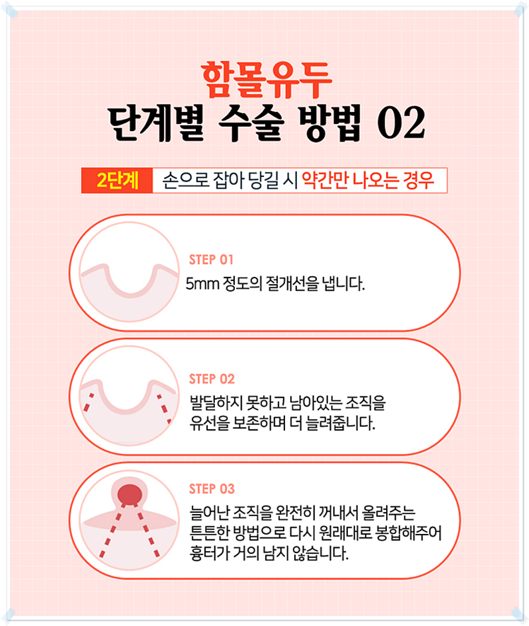 함몰유두수술가격 단계별로 생각해보자! 관련 이미지 8