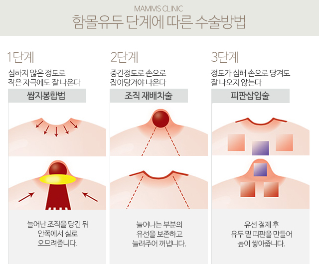 함몰유두수유 걱정덜기 관련 이미지 3