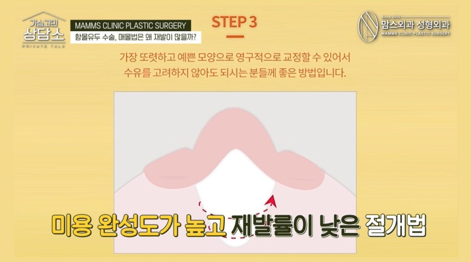 모유수유냐, 모양이냐! 나에게 맞는 함몰유두 수술법은? 관련 이미지 5