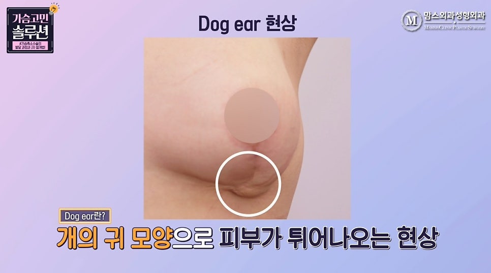 Looking at the J-Shaped Incision Method for Breast Reduction with Photos! image 10