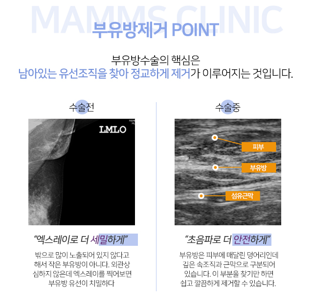 부유방지방흡입 근본적원인체크 관련 이미지 3