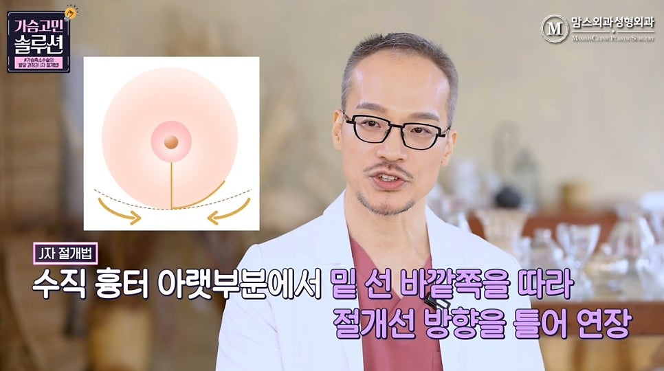 Looking at the J-Shaped Incision Method for Breast Reduction with Photos! image 13