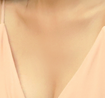 겨드랑이몽우리 라인부터 재발까지 생각하는 솔루션! 관련 이미지 18