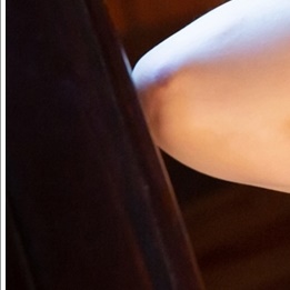 When Is Axillary Breast Tissue Liposuction Possible? image 19