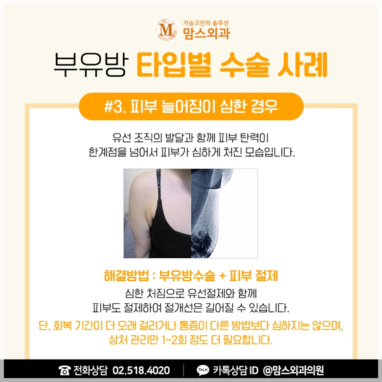부유방빼기 꼼꼼하게 체크해요. 관련 이미지 7