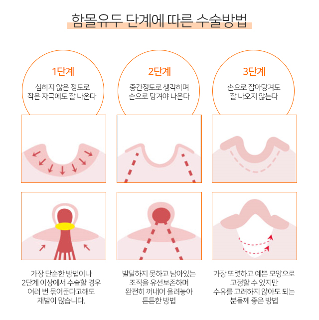 함몰유두수술비용 이것저것따져봐도 관련 이미지 3
