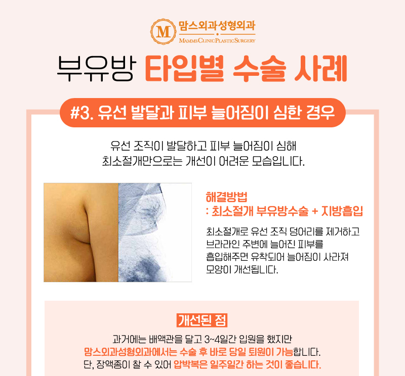 겨드랑이볼록 부유방 덜어내고 편안한 일상으로! 관련 이미지 5